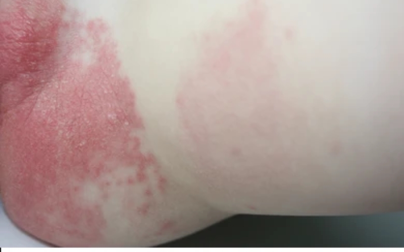 symptoms of diaper rash